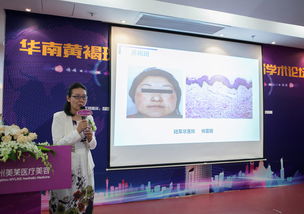广州美莱首推签约祛斑责任制 助祛斑失败毁容女士修复治疗